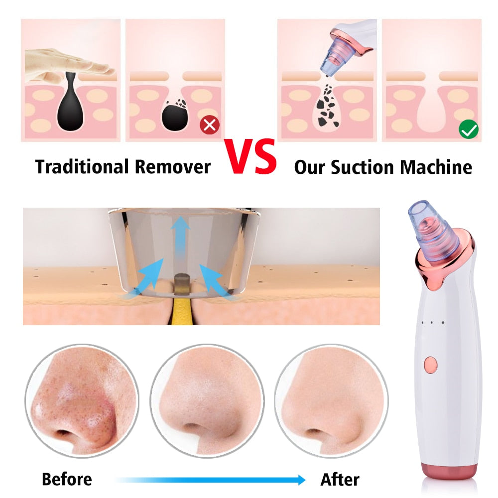 Poreva™ Pore Vacuum & Blackhead Extractor